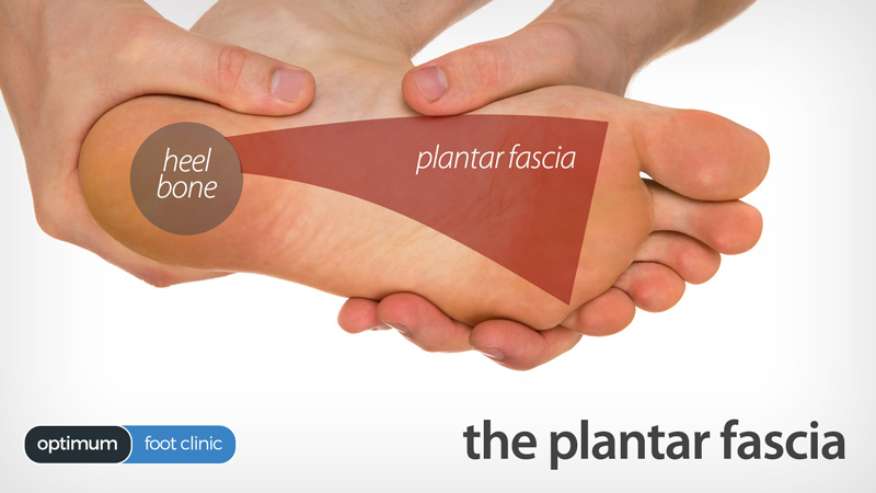 Image result for plantar fasciitis